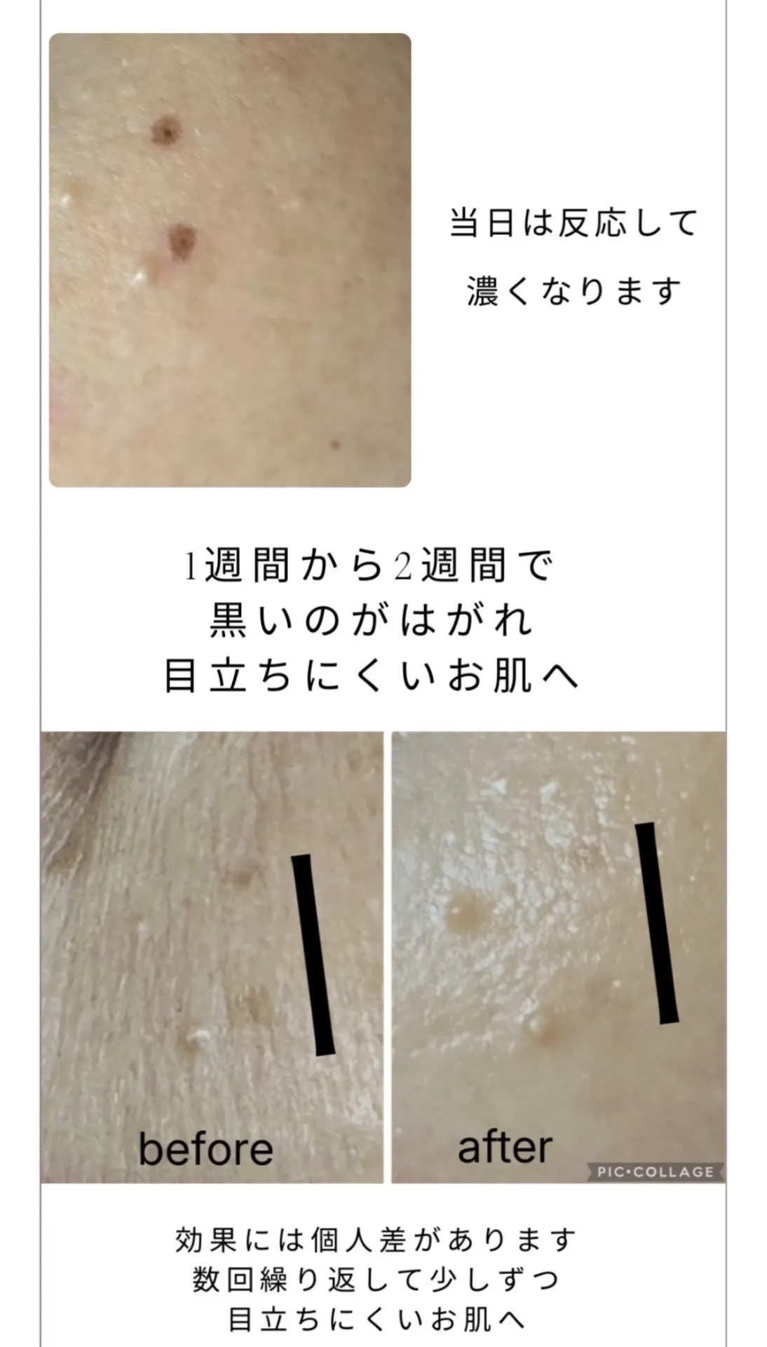 シミケア経過